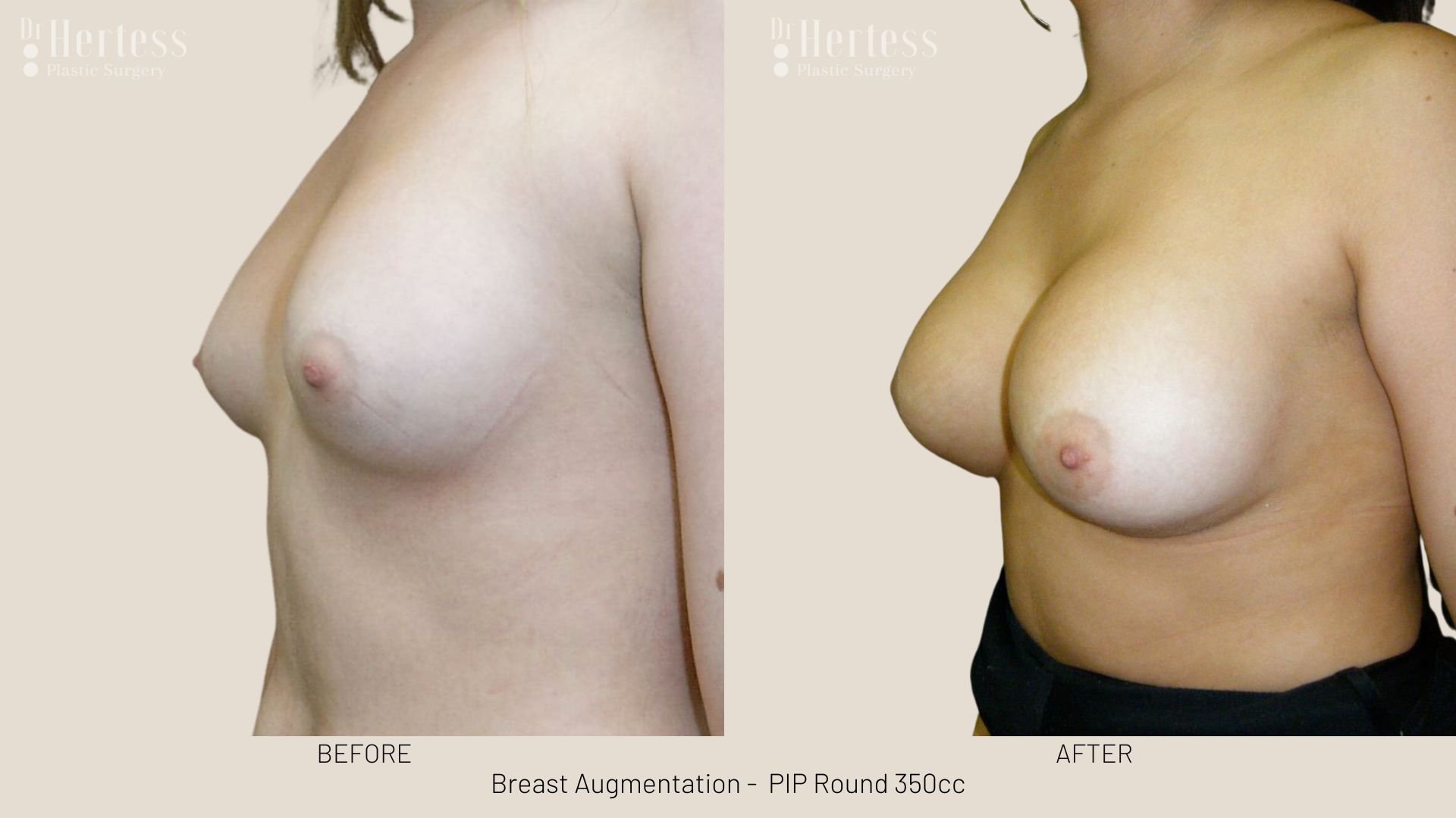 breast implant photos