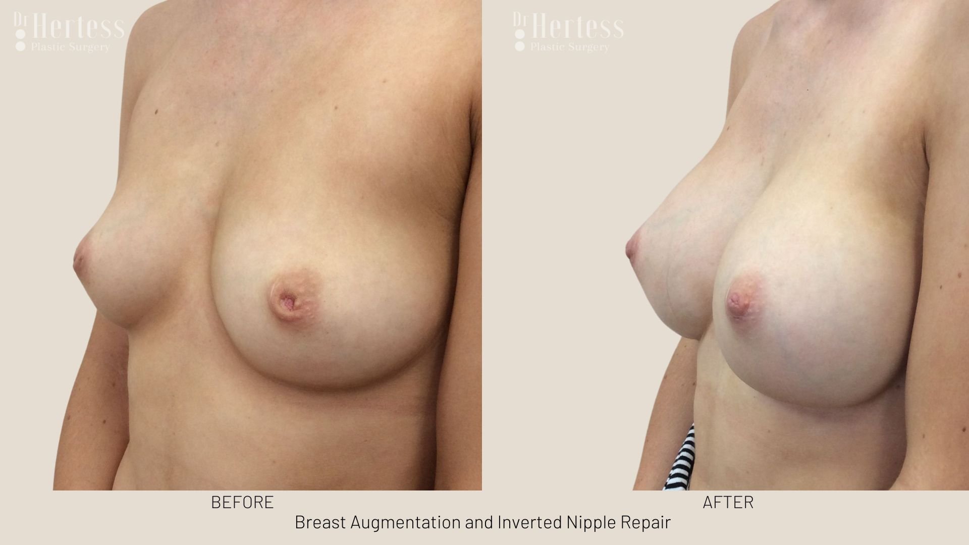 surgery for inverted nipple