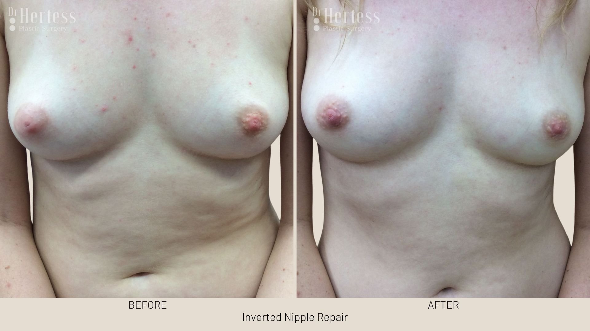 surgery for inverted nipple