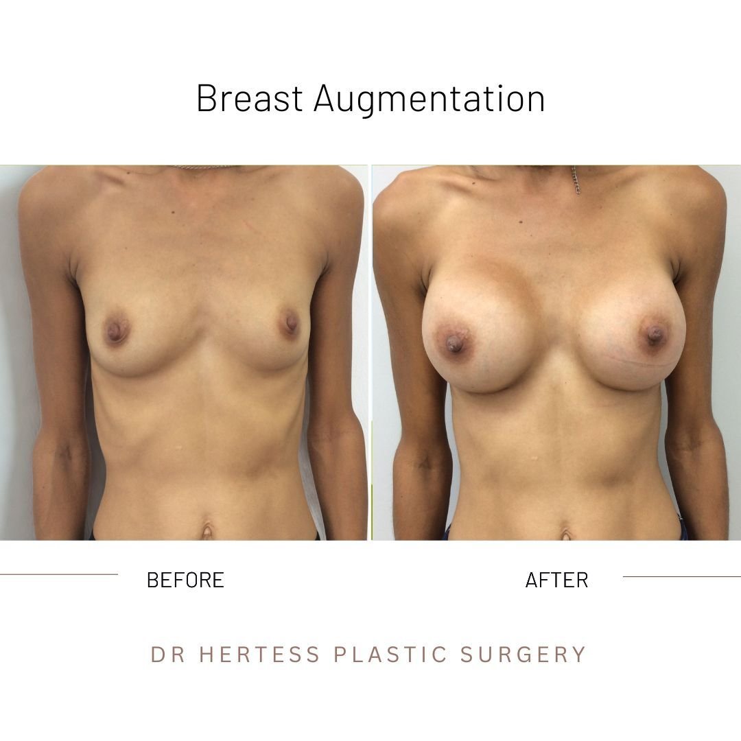 breast enhancement