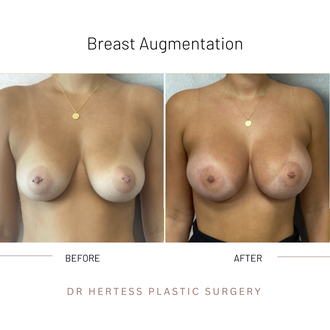GALLERY - BREAST AUGMENTATION