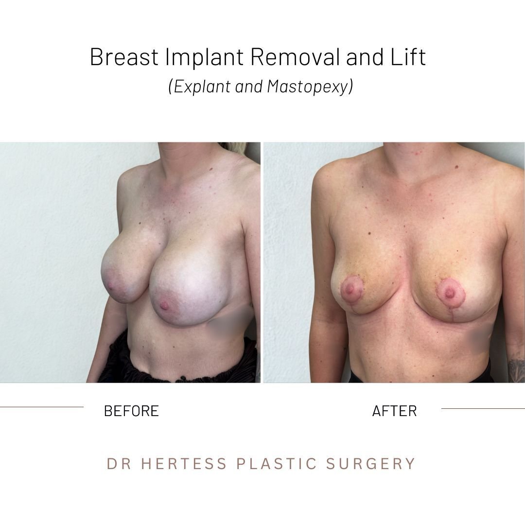 GALLERY - EXPLANT + LIFT