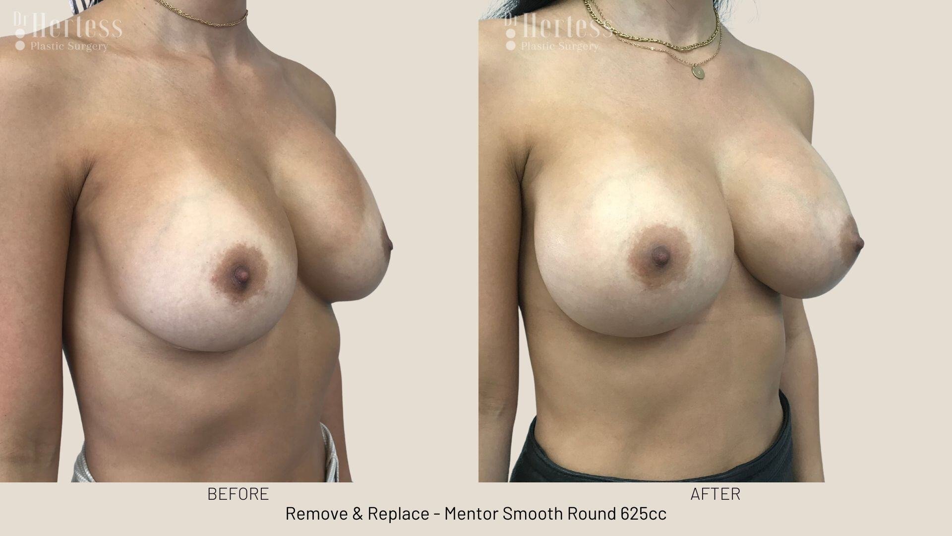 remove replace photos