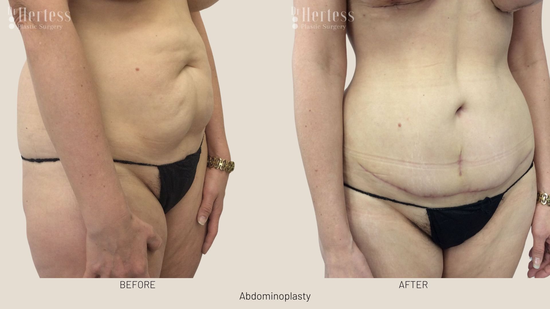 abdominoplasty