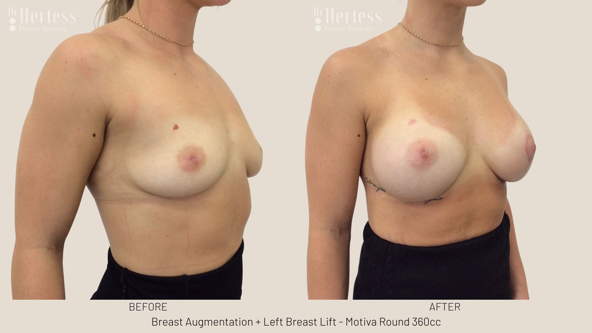 breast lift and augmentation before and after