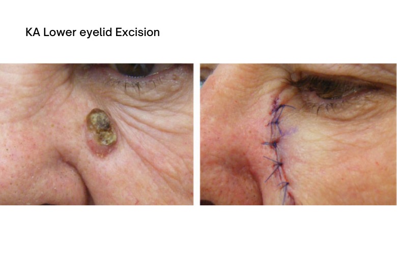BCC-Excision-2