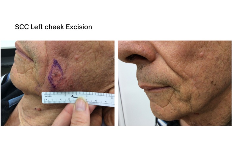 BCC-Excision-3