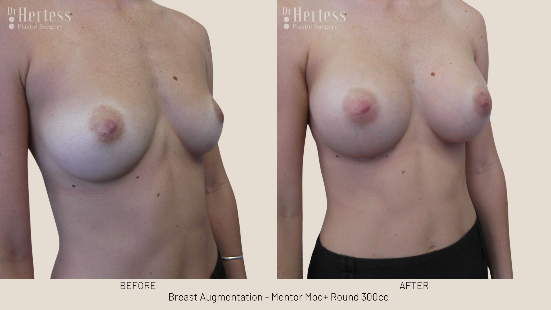 breast enhancement pics gold coast