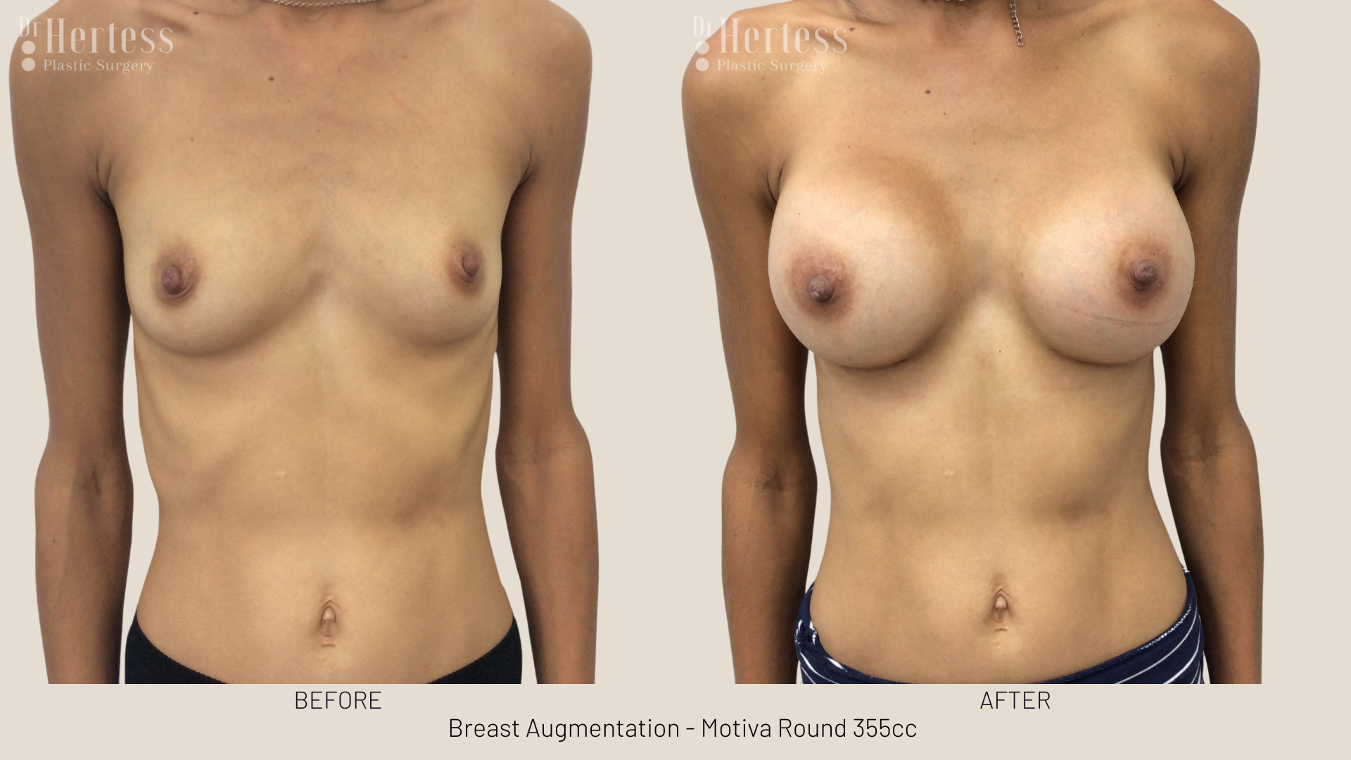 breast implants gold coast