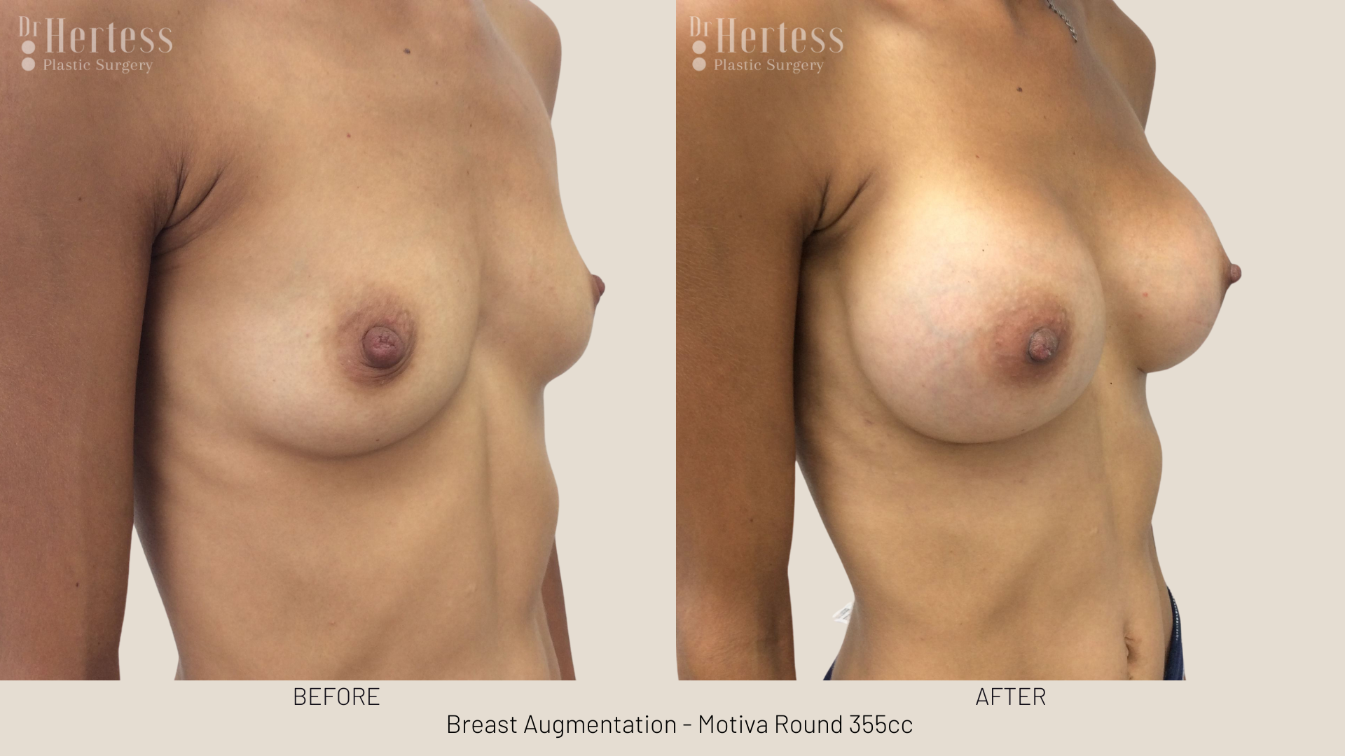 breast implants gold coast