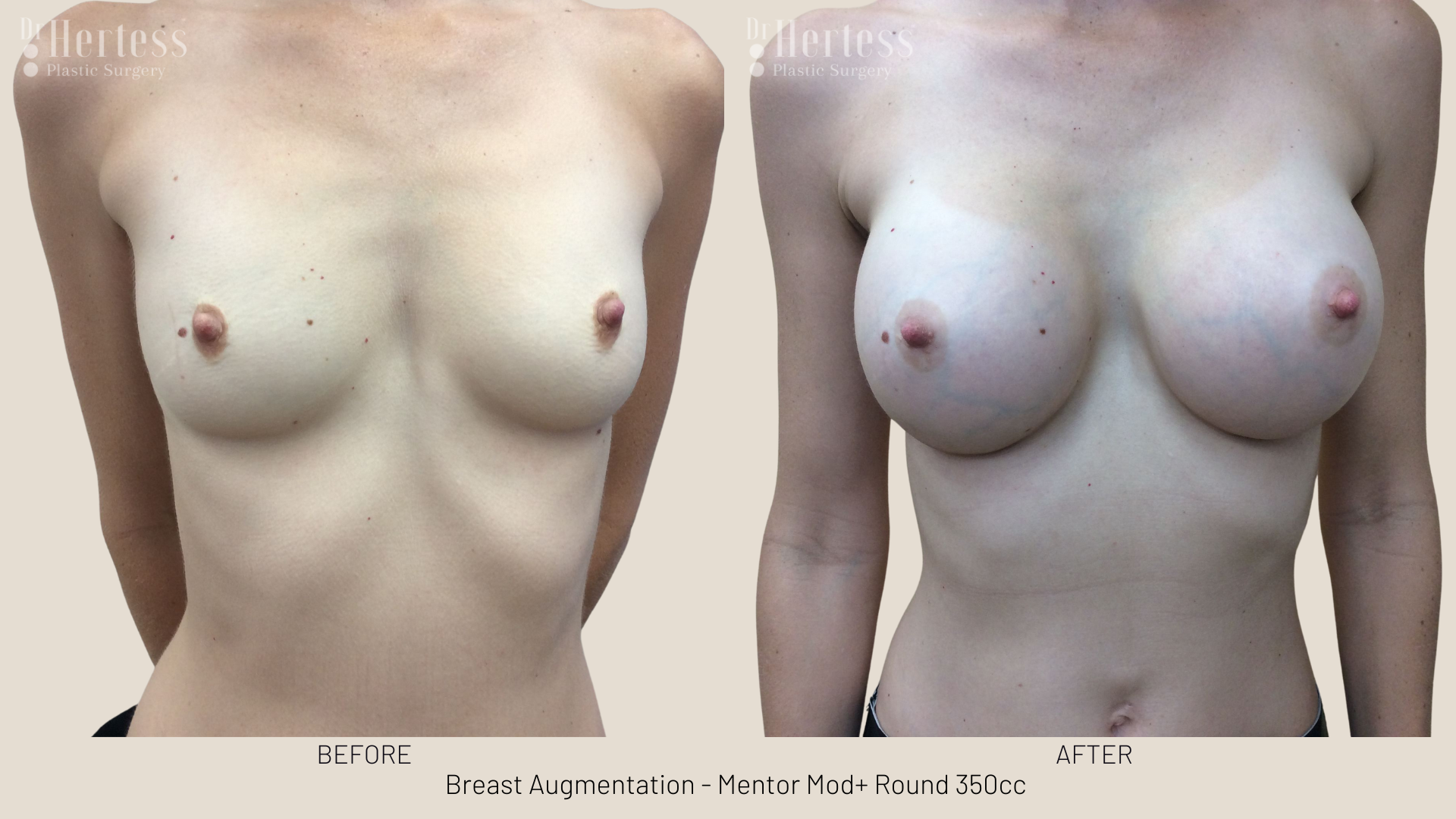 breast implants gold coast