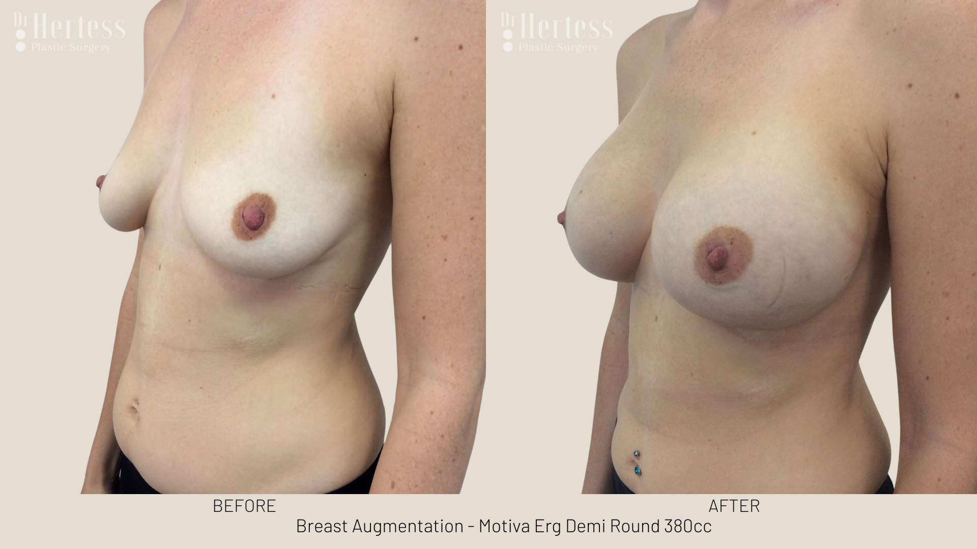 breast implants gold coast