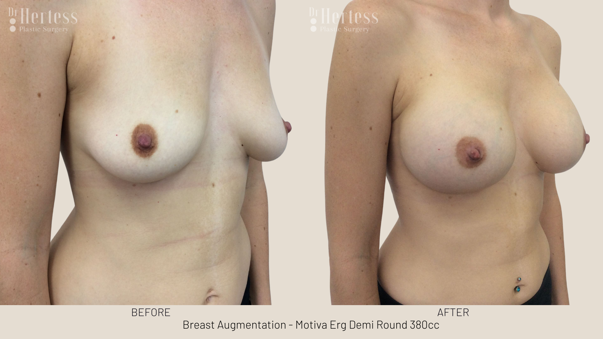breast implants gold coast