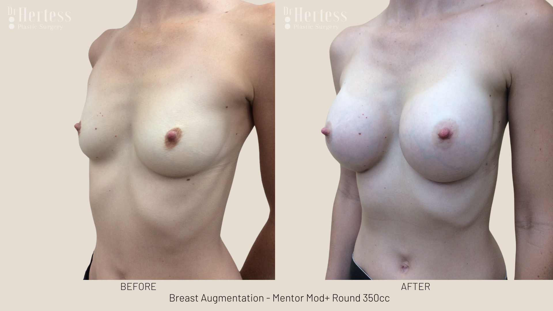 breast implants gold coast