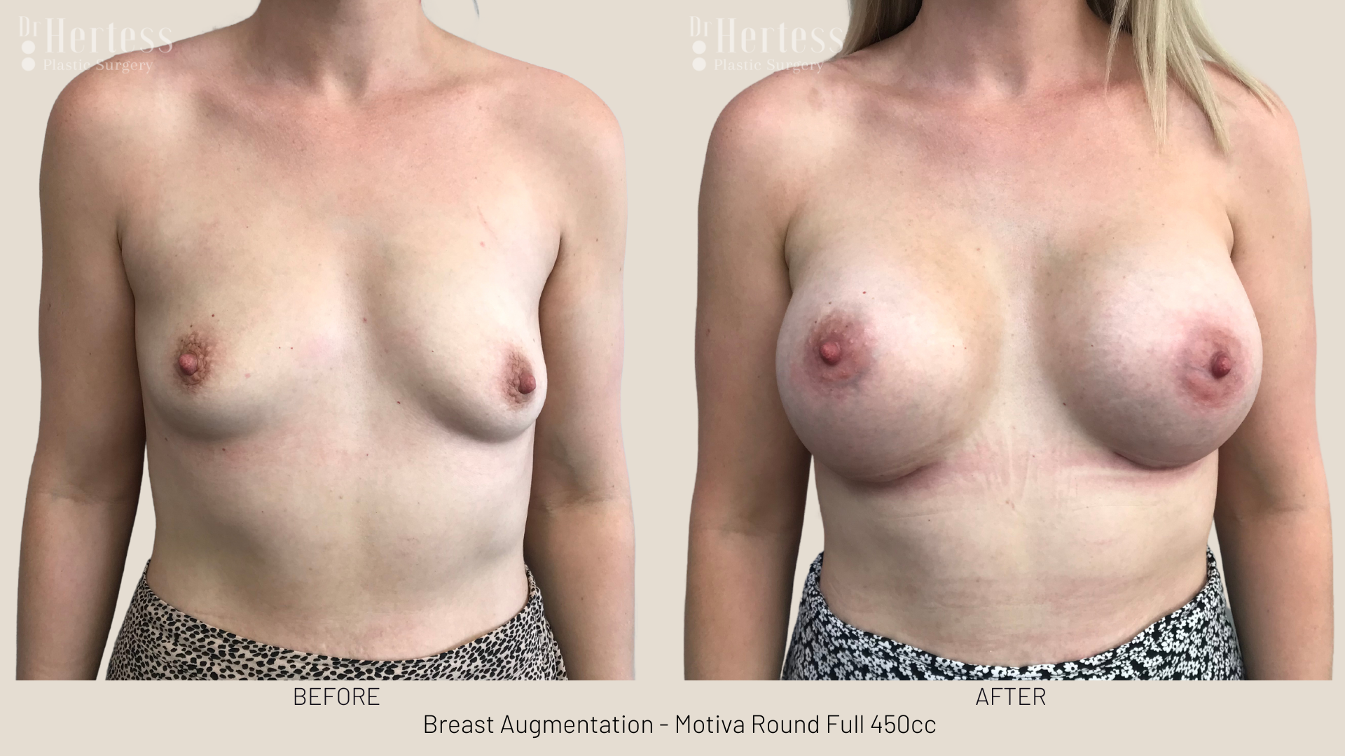 breast augmentation pics gold coast