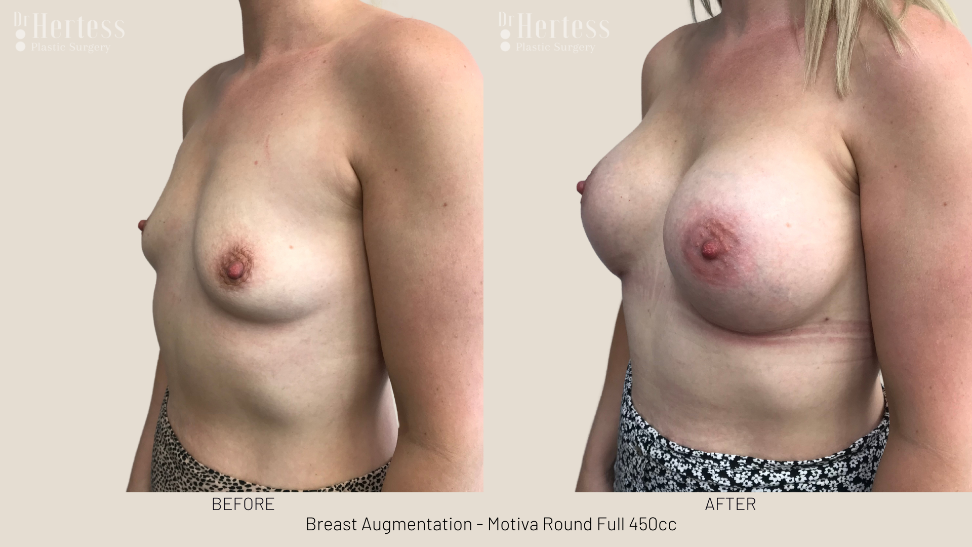 breast augmentation pics gold coast