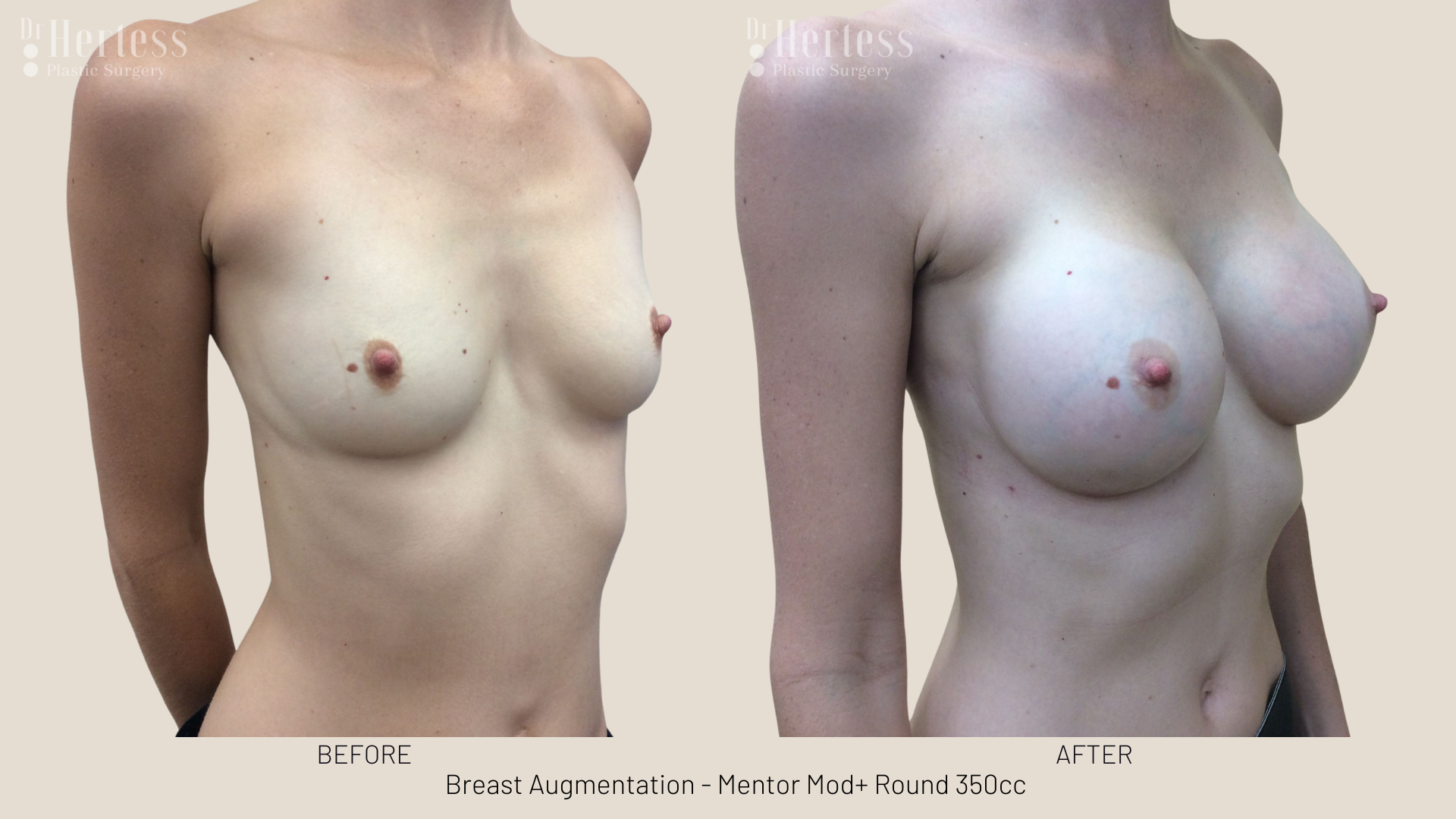 breast implants gold coast