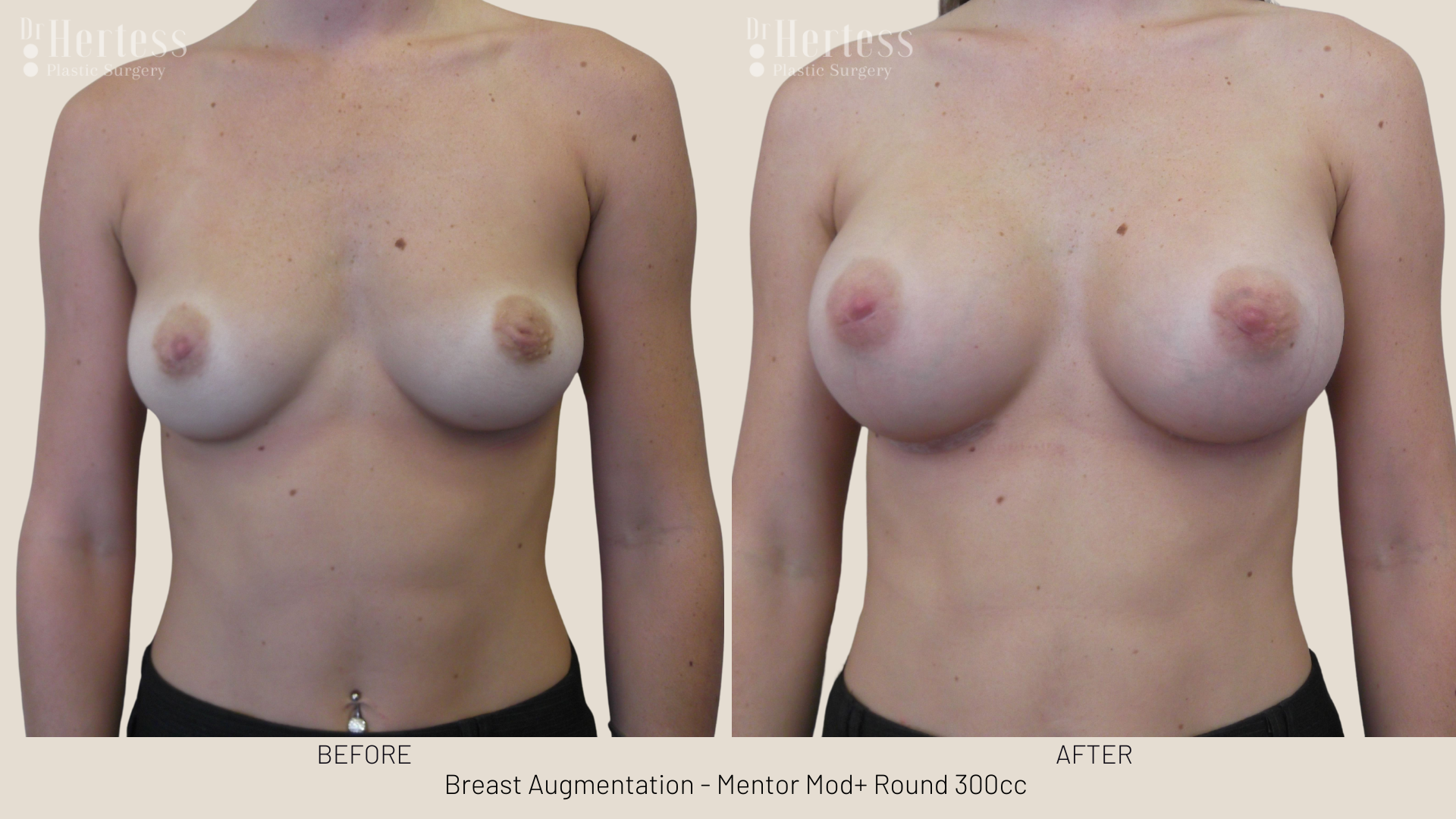 breast enhancement pics gold coast