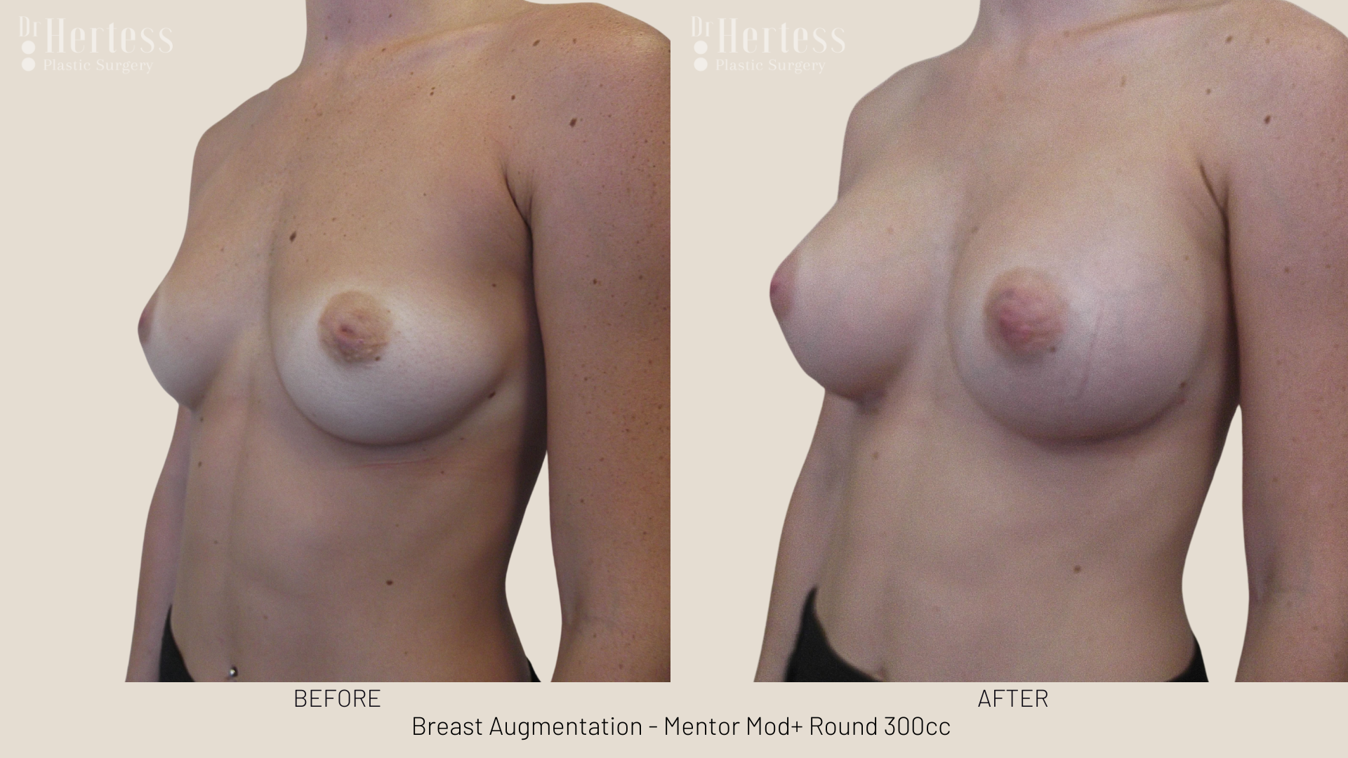 breast enhancement pics gold coast