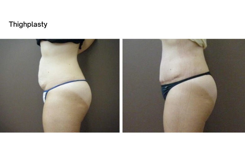 Thighplasty