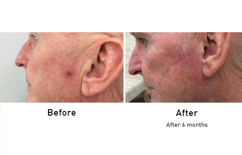 cairns_before-after_gallery-18-1