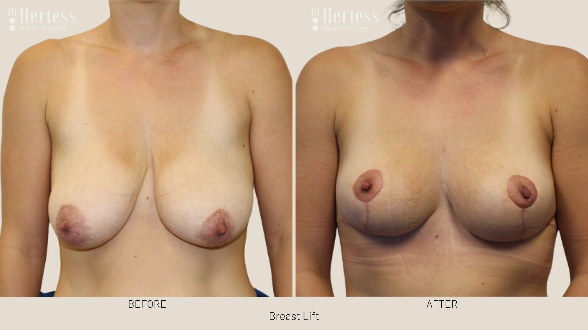 breast lift before and afters