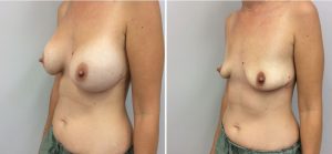 Breast Implant Removal (Explant) Patient 10